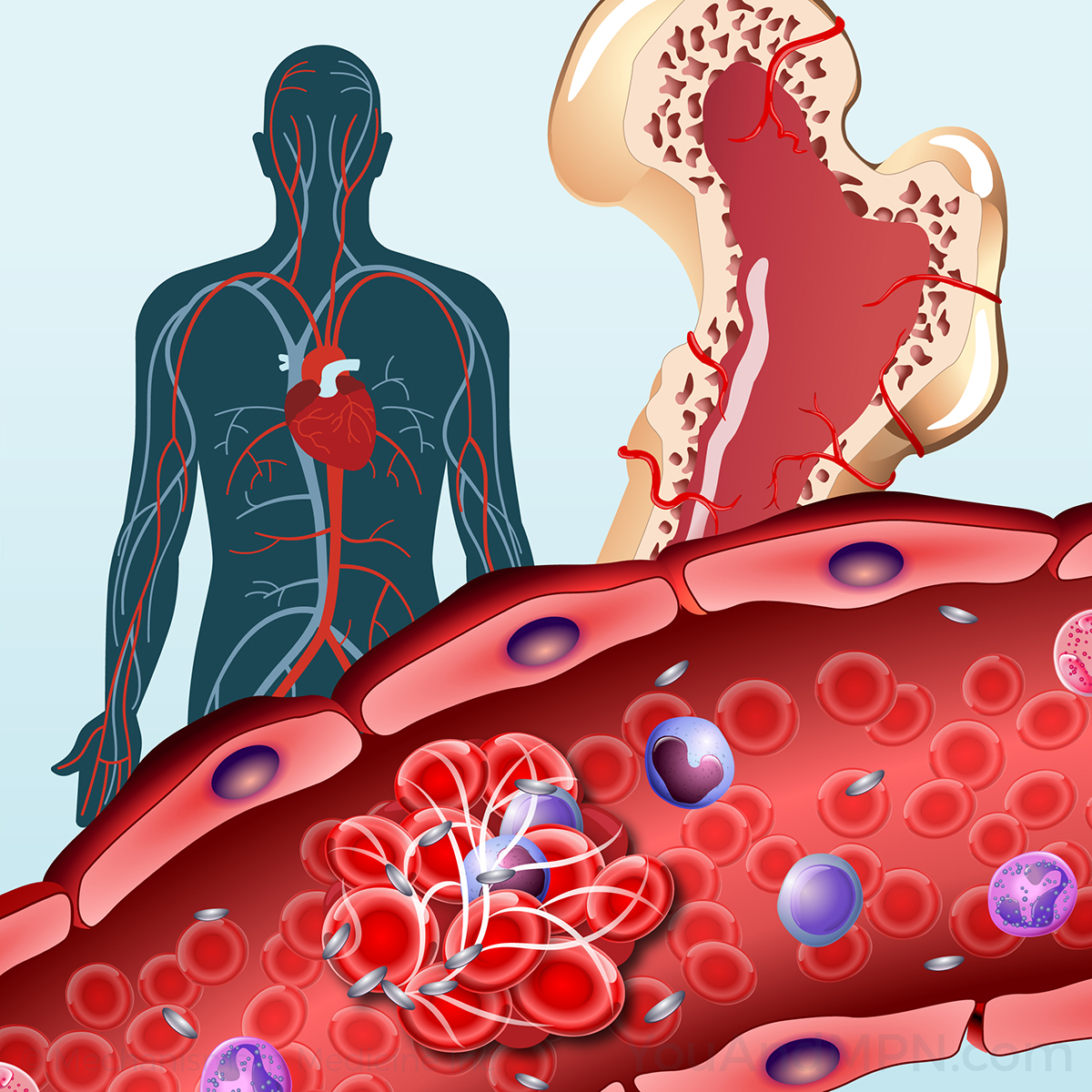 Understanding and Diagnosing MPNs