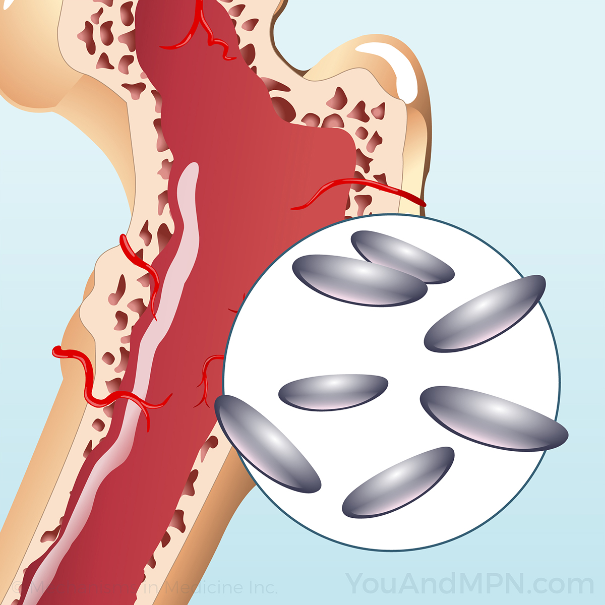 Essential Thrombocythemia (ET)